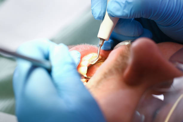 Best Emergency Wisdom Tooth Extraction in Norwood Young America, MN